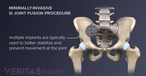 sacral osteopathy ambulation